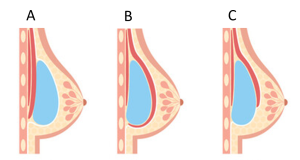Ilustração que mostra os três planos de colocação de implantes mamários possíveis